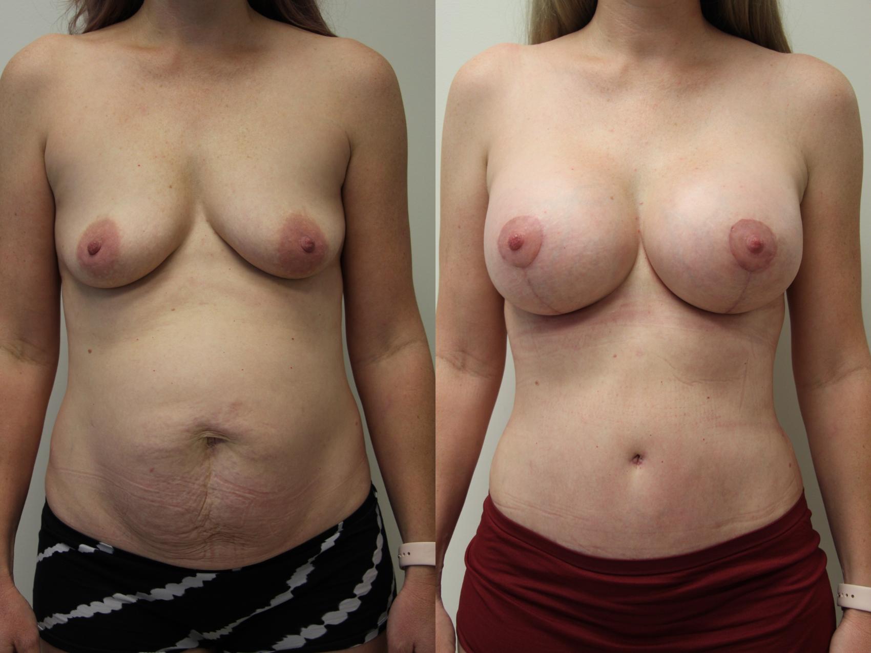 Before & After Tummy Tuck (Abdominoplasty) Case 406 Front View in Gilbert, AZ