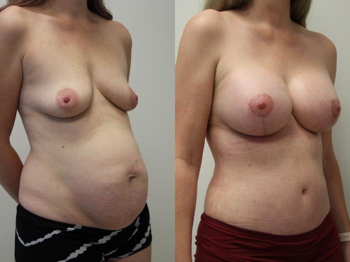 Before & After Mommy Makeover Case 406 Right Oblique View in Gilbert, AZ