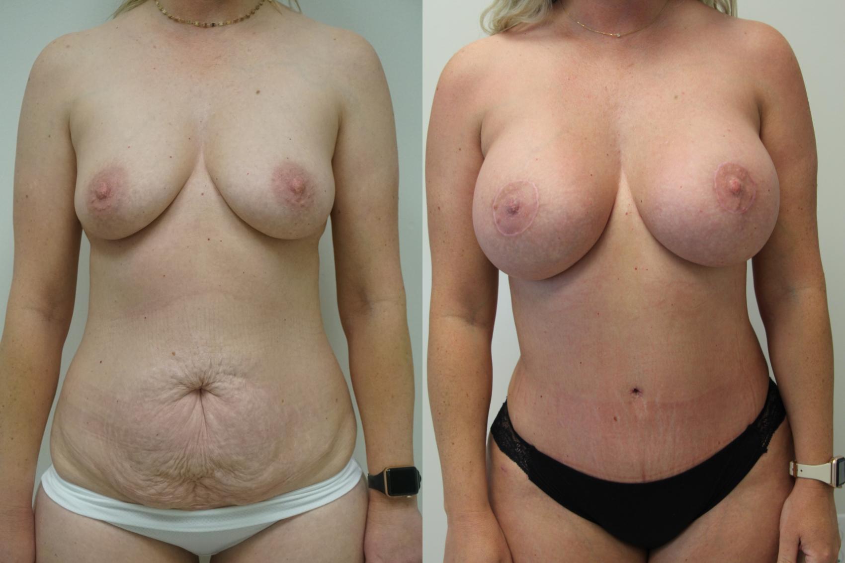 Before & After Breast Augmentation with Breast Lift  Case 407 Front View in Gilbert, AZ