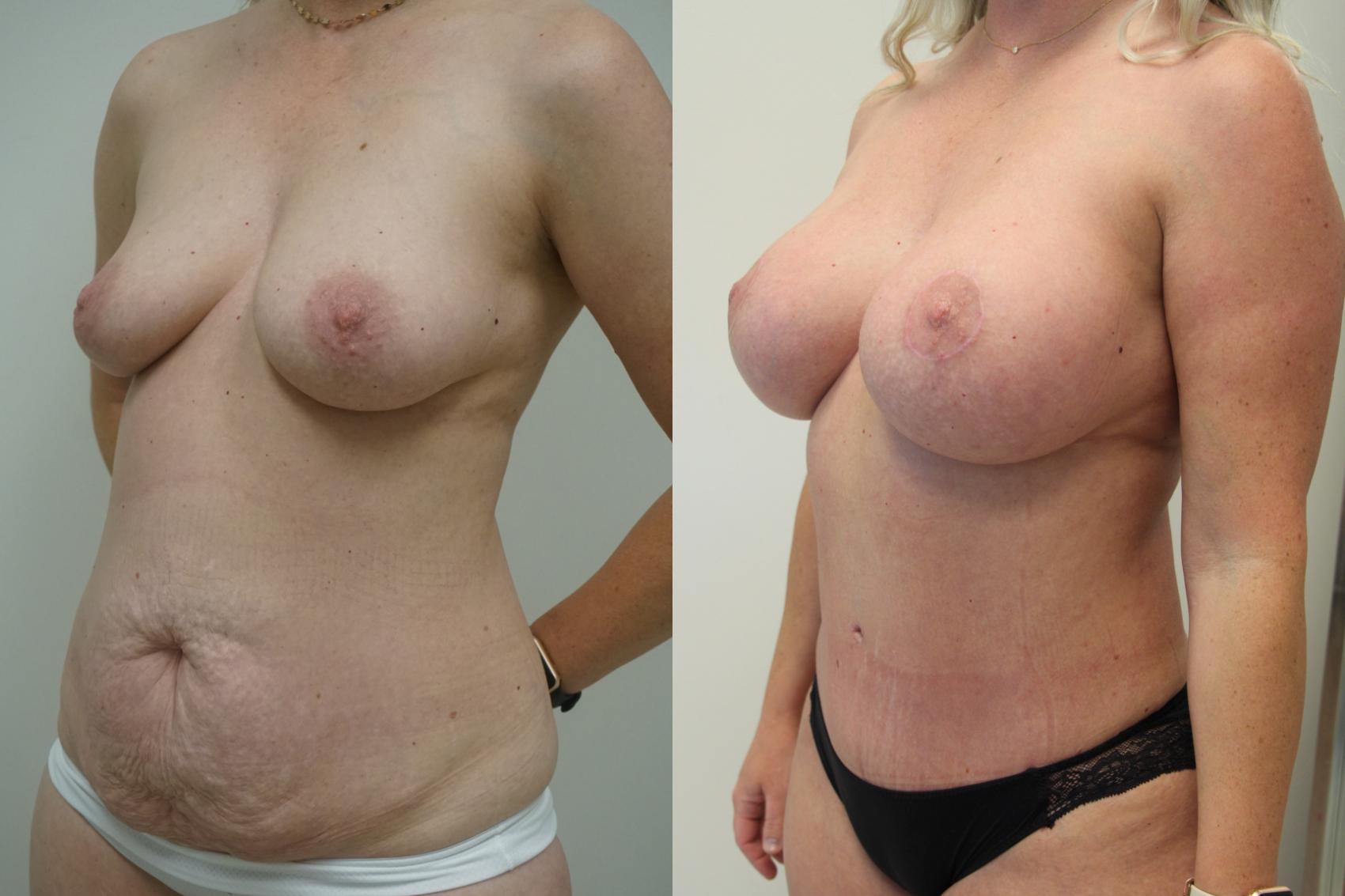 Before & After Breast Augmentation with Breast Lift  Case 407 Left Oblique View in Gilbert, AZ