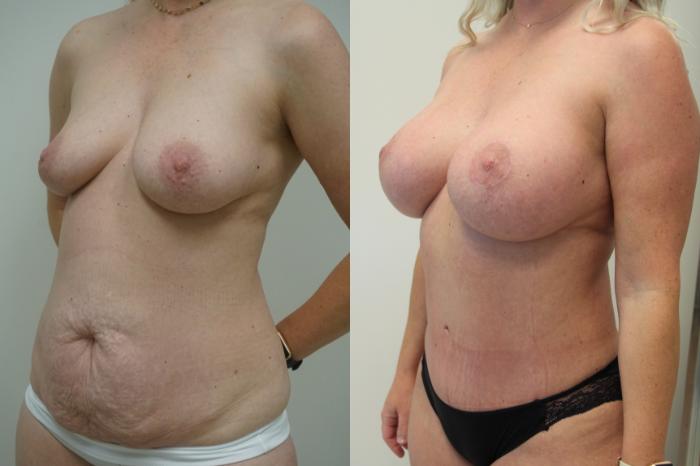 Before & After Mommy Makeover Case 407 Left Oblique View in Gilbert, AZ