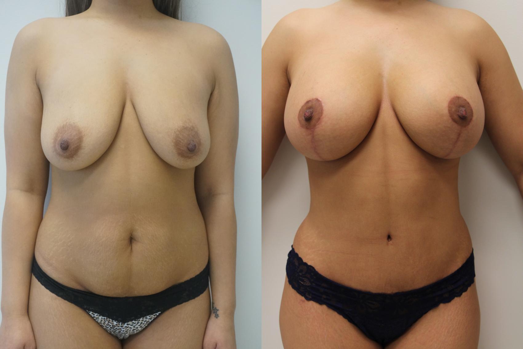 Before & After Tummy Tuck (Abdominoplasty) Case 408 Front View in Gilbert, AZ