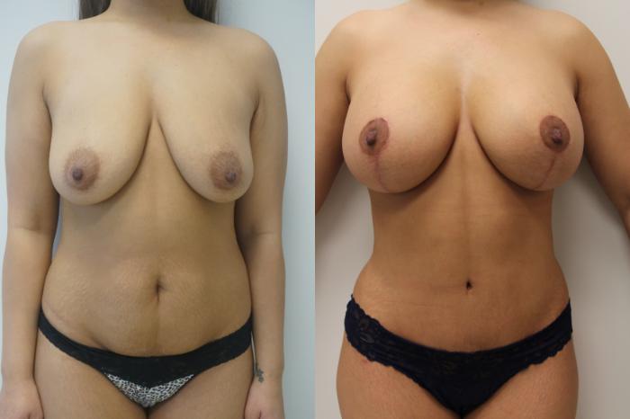 Before & After Breast Augmentation with Breast Lift  Case 408 Front View in Gilbert, AZ