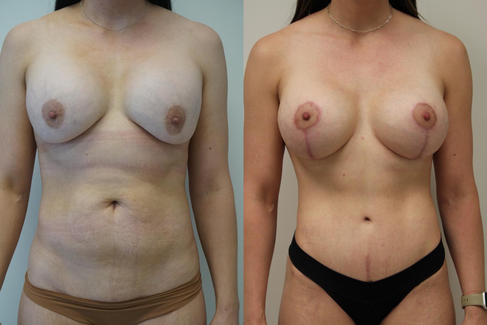 Before & After Tummy Tuck (Abdominoplasty) Case 420 Front View in Gilbert, AZ