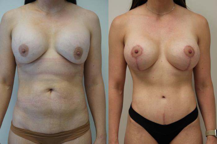 Before & After Breast Implant Exchange Case 420 Front View in Gilbert, AZ