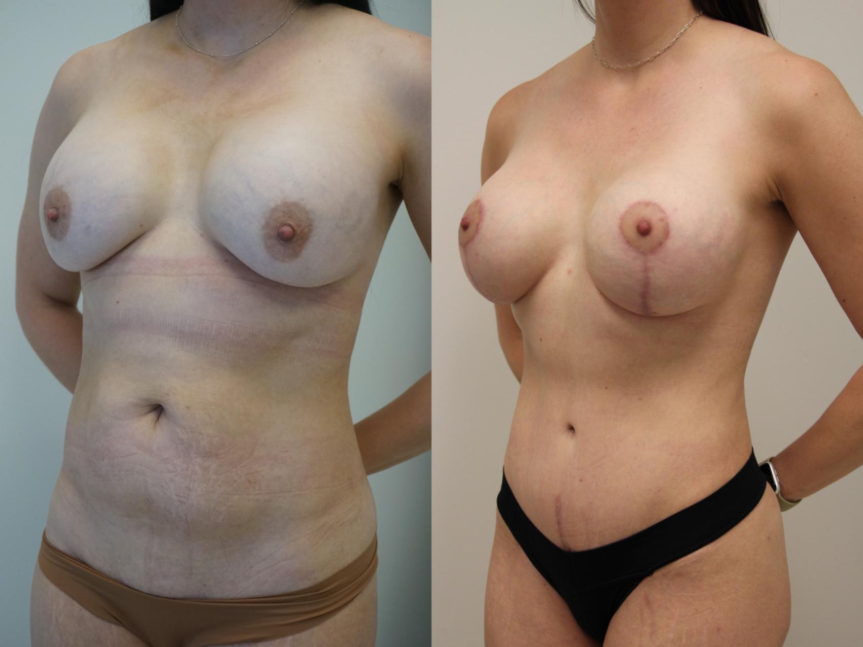 Before & After Breast Implant Exchange Case 420 Left Oblique View in Gilbert, AZ