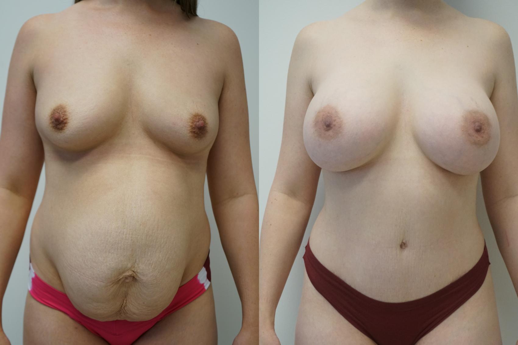 Before & After Breast Augmentation Case 421 Front View in Gilbert, AZ