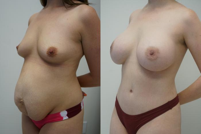 Before & After Breast Augmentation Case 421 Left Oblique View in Gilbert, AZ