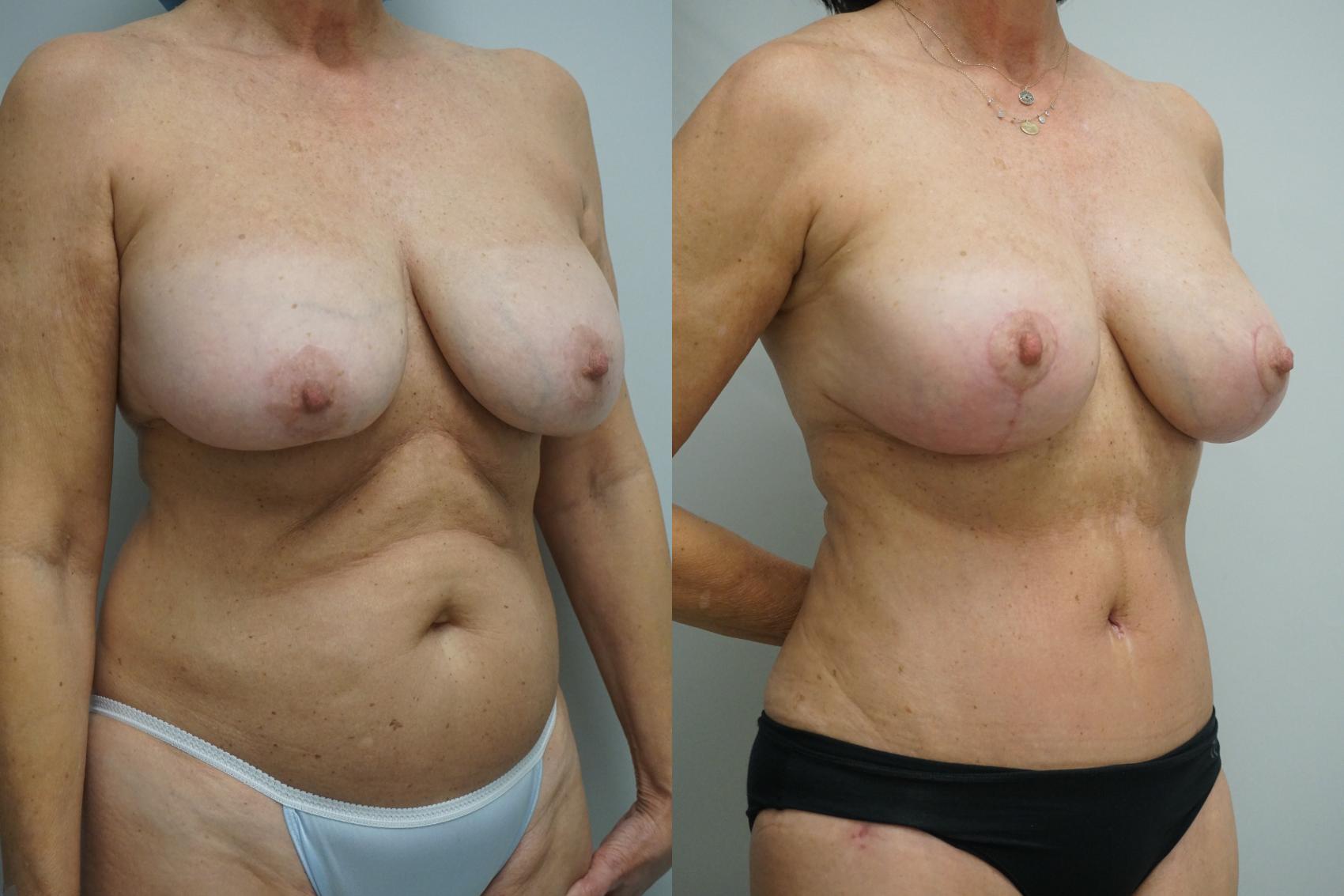 Before & After Tummy Tuck (Abdominoplasty) Case 424 Right Oblique View in Gilbert, AZ