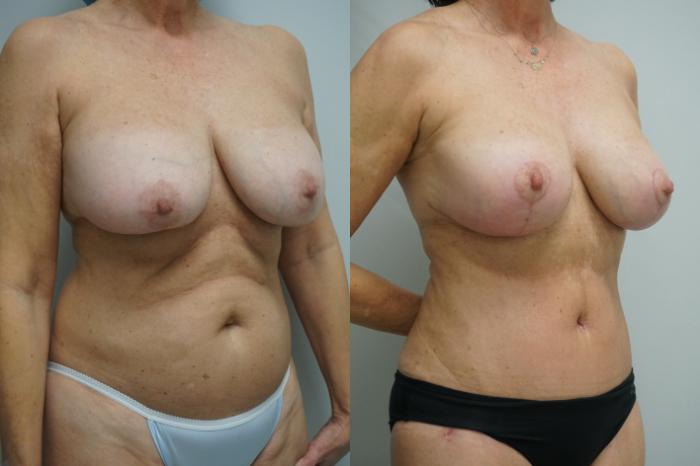 Before & After Breast Implant Exchange Case 424 Right Oblique View in Gilbert, AZ