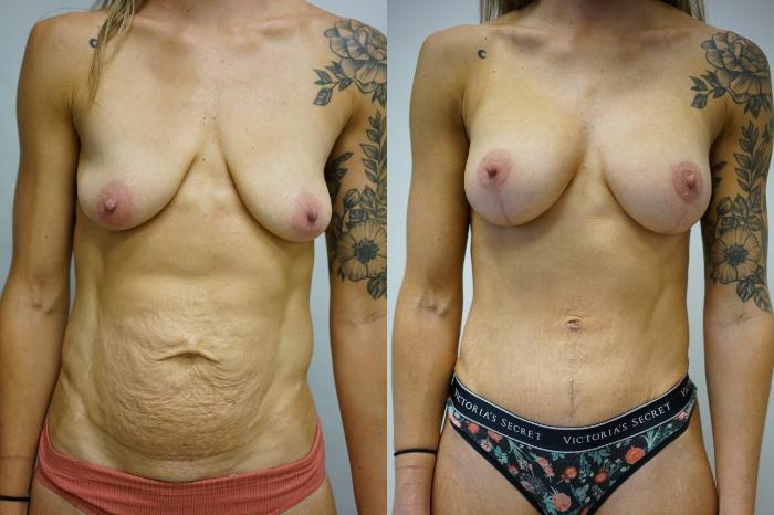 Before & After Breast Augmentation with Breast Lift  Case 427 Front View in Gilbert, AZ