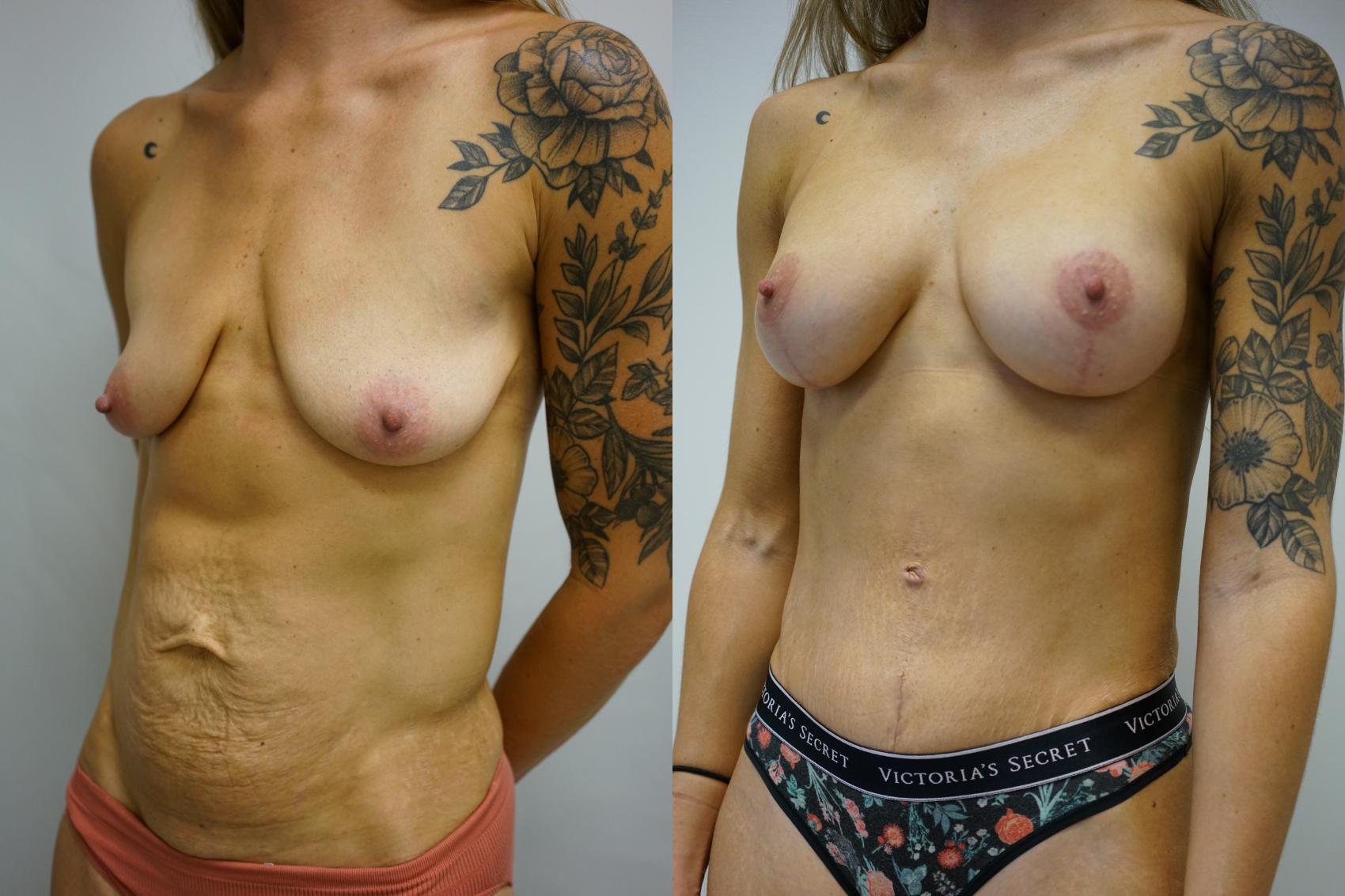 Before & After Mommy Makeover Case 427 Left Oblique View in Gilbert, AZ