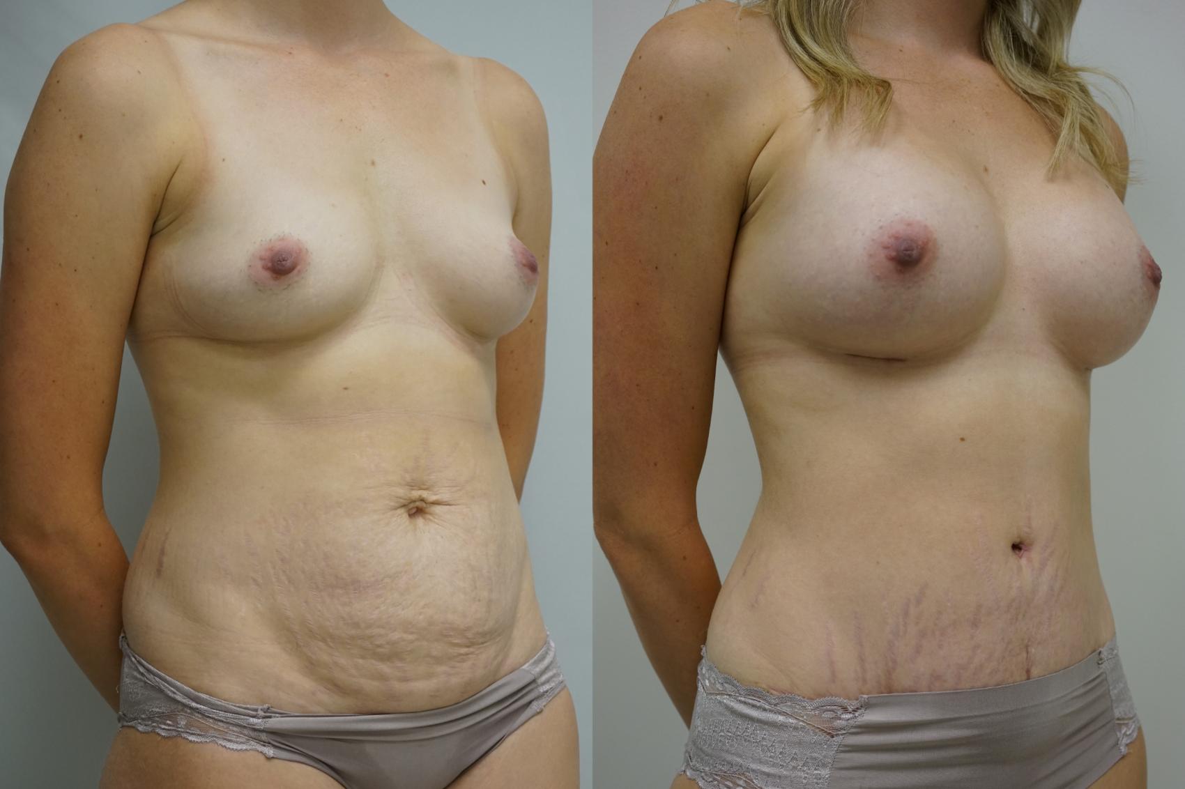 Before & After Mommy Makeover Case 430 Right Oblique View in Gilbert, AZ