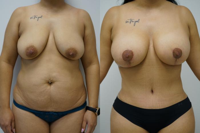 Before & After Breast Augmentation with Breast Lift Case 431 Front View in Gilbert, AZ