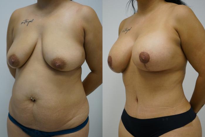 Before & After Breast Augmentation with Breast Lift  Case 431 Left Oblique View in Gilbert, AZ