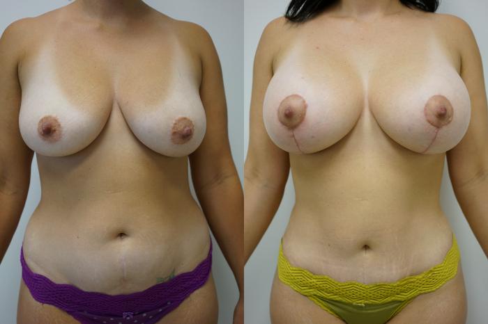 Before & After Breast Augmentation with Breast Lift Case 434 Front View in Gilbert, AZ