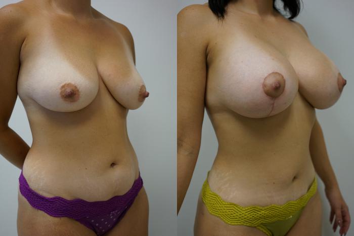 Before & After Tummy Tuck (Abdominoplasty) Case 434 Right Oblique View in Gilbert, AZ