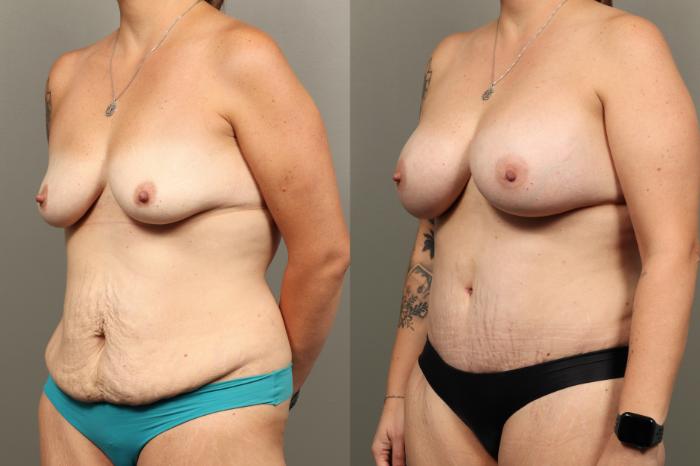 Before & After Mommy Makeover Case 457 Left Oblique View in Gilbert, AZ