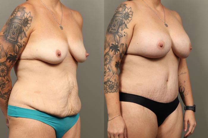 Before & After Mommy Makeover Case 457 Right Oblique View in Gilbert, AZ