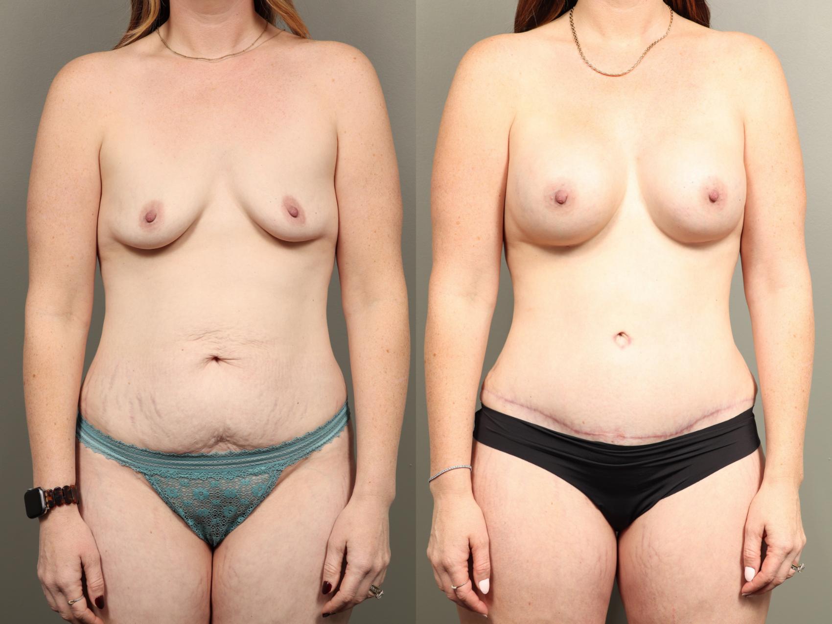 Before & After Mommy Makeover Case 475 Front View in Gilbert, AZ