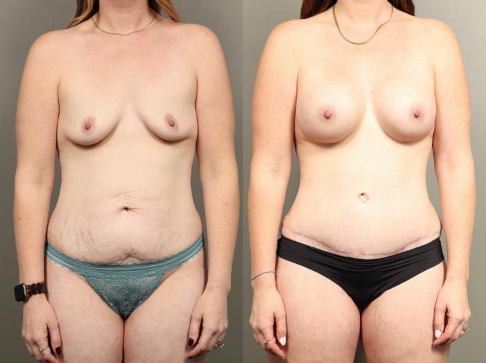 Before & After Mommy Makeover Case 475 Front View in Gilbert, AZ