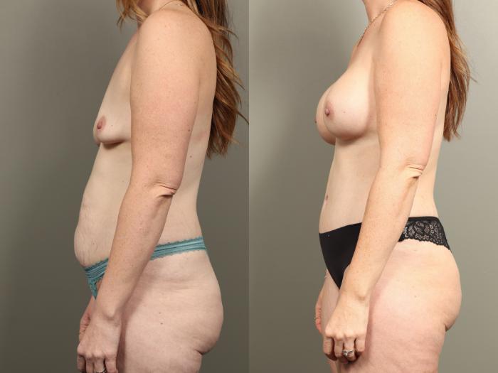 Before & After Mommy Makeover Case 475 Left Side View in Gilbert, AZ