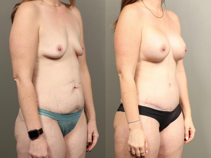 Before & After Mommy Makeover Case 475 Right Oblique View in Gilbert, AZ