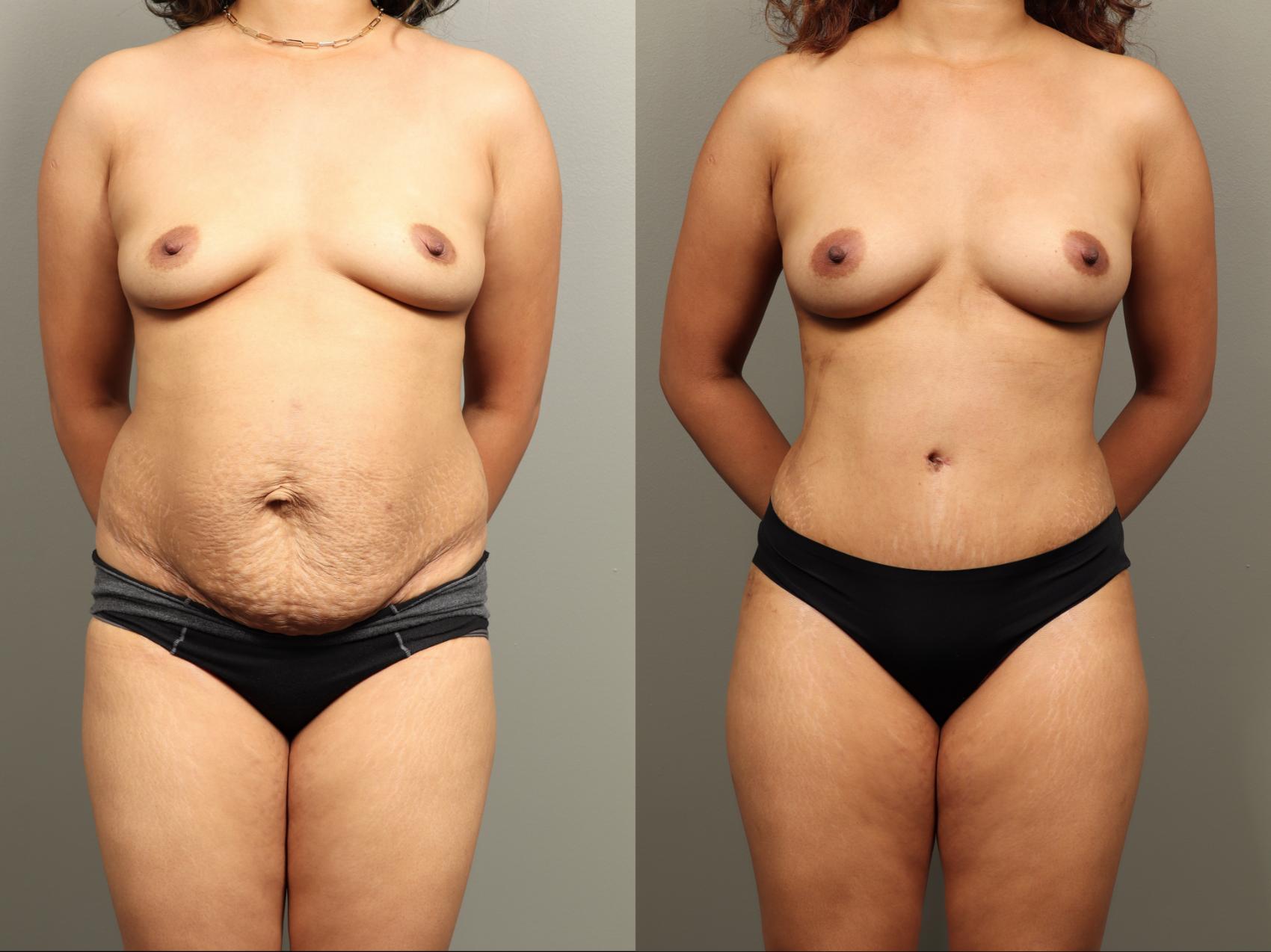 Before & After Mommy Makeover Case 484 Front View in Gilbert, AZ