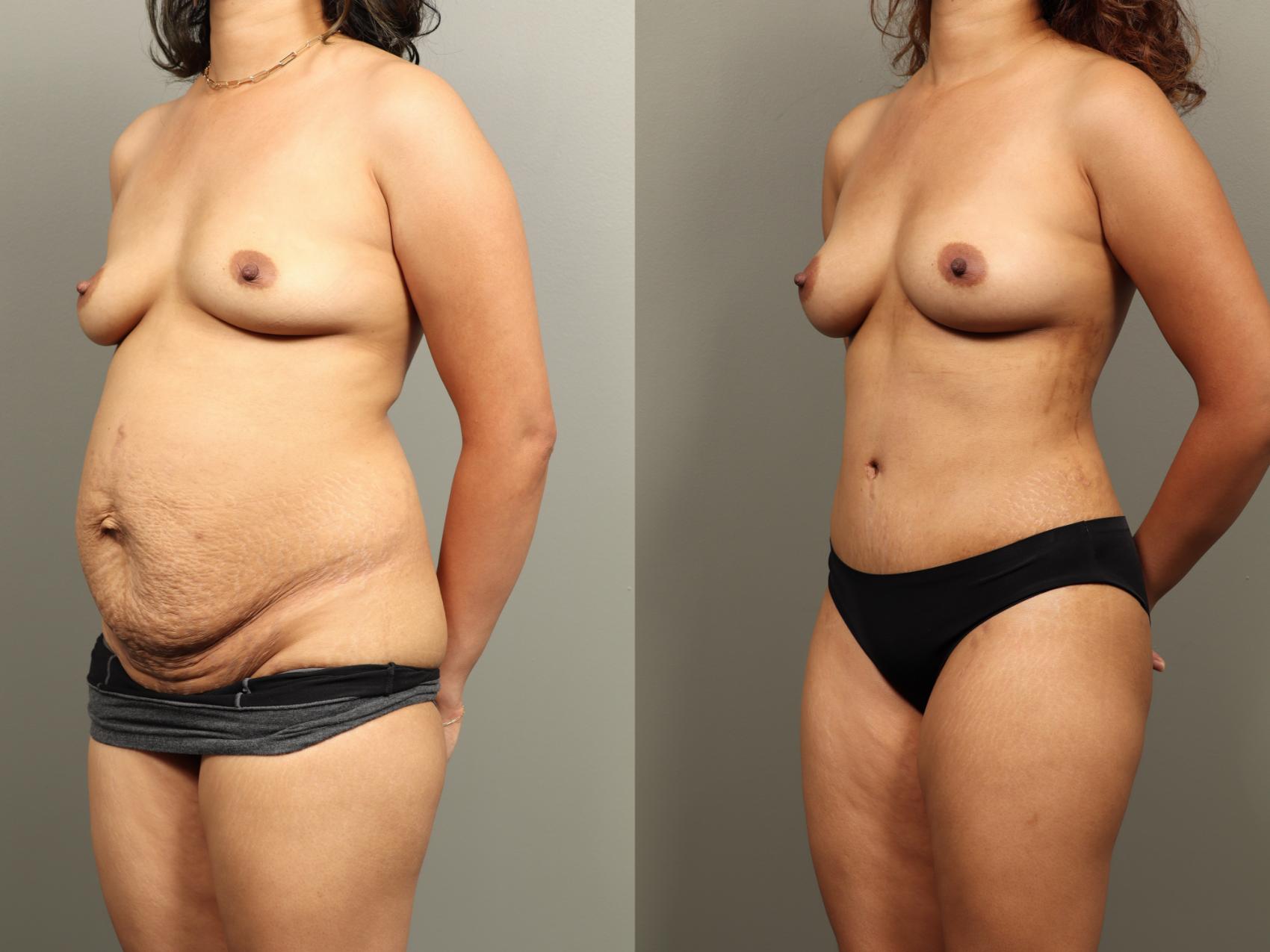 Before & After Mommy Makeover Case 484 Left Oblique View in Gilbert, AZ