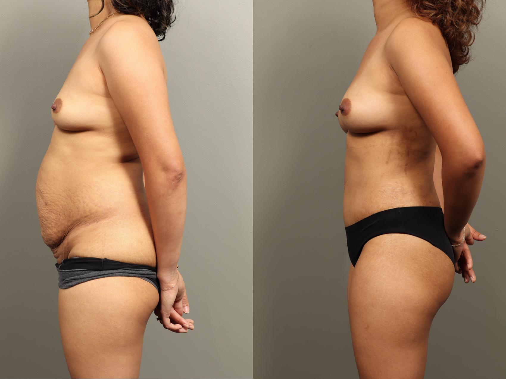 Before & After Mommy Makeover Case 484 Left Side View in Gilbert, AZ