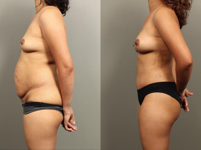 Before & After Mommy Makeover Case 484 Left Side View in Gilbert, AZ