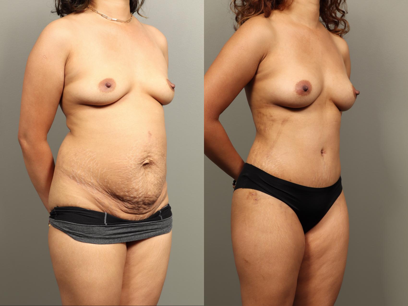 Before & After Mommy Makeover Case 484 Right Oblique View in Gilbert, AZ