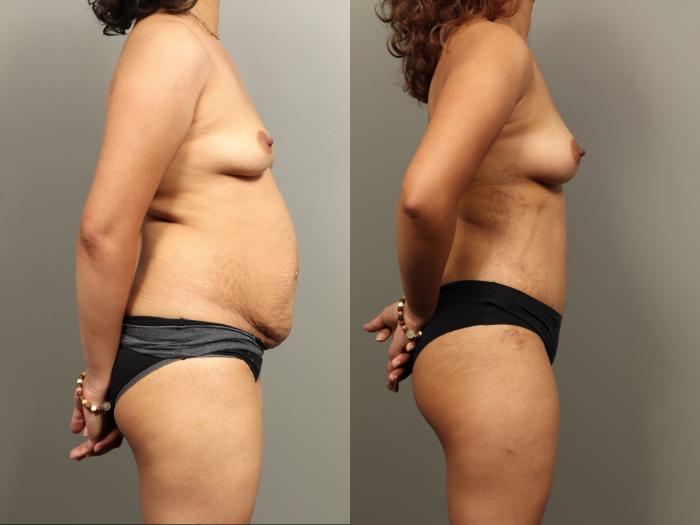 Before & After Mommy Makeover Case 484 Right Side View in Gilbert, AZ