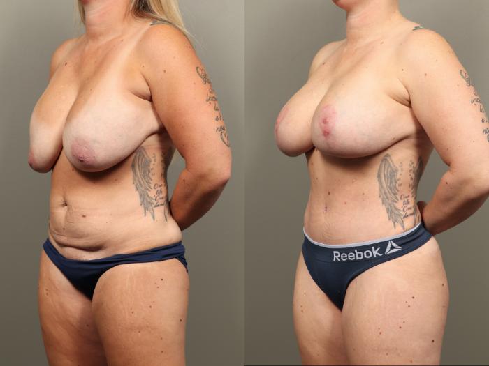 Before & After Mommy Makeover Case 488 Left Oblique View in Gilbert, AZ