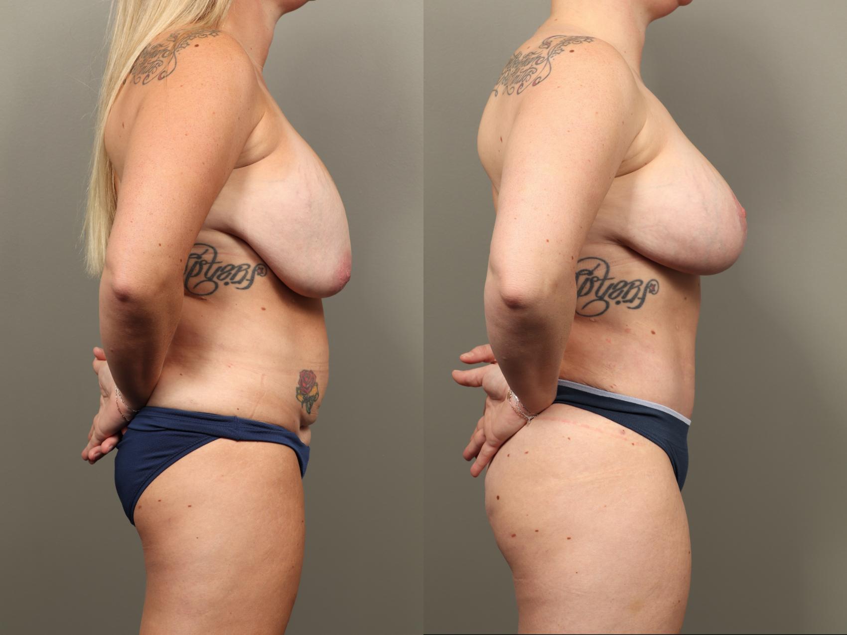 Before & After Mommy Makeover Case 488 Right Side View in Gilbert, AZ