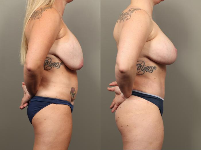 Before & After Mommy Makeover Case 488 Right Side View in Gilbert, AZ