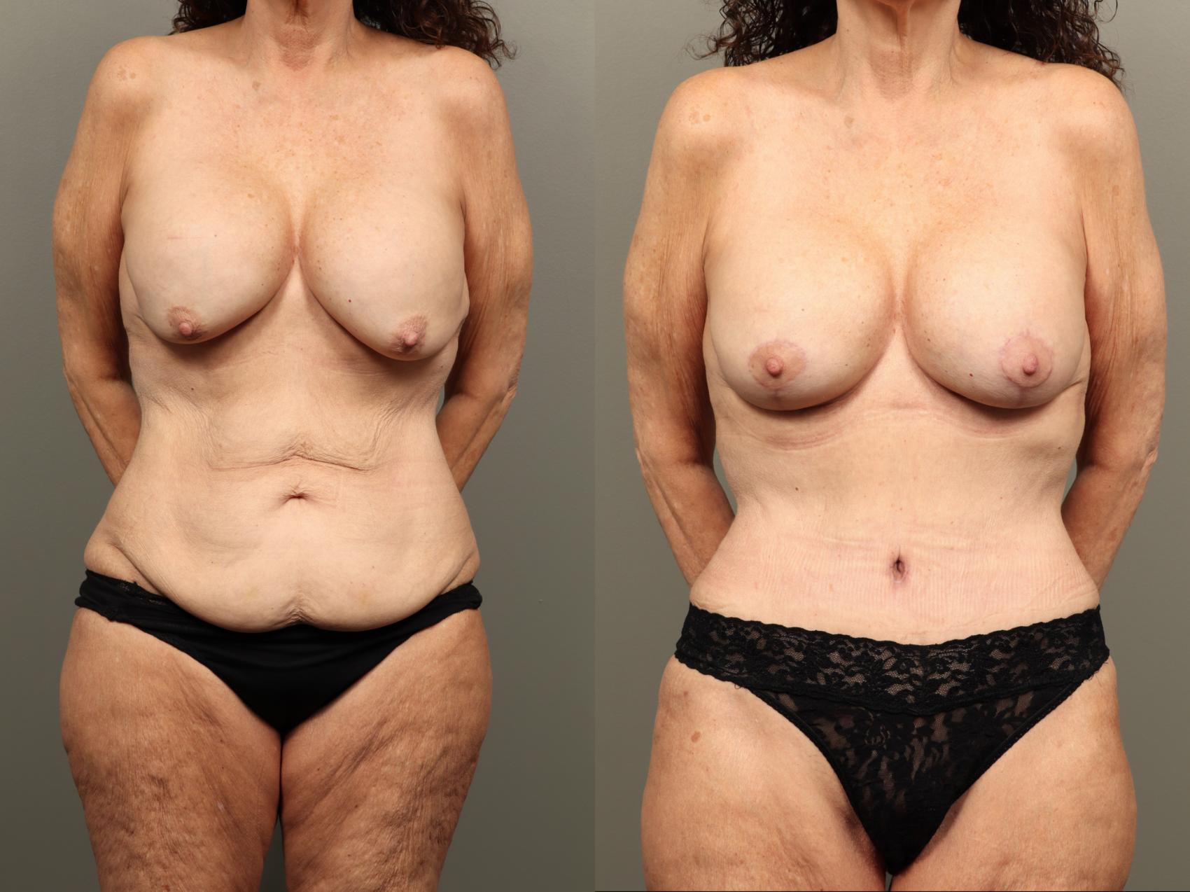 Before & After Mommy Makeover Case 490 Front View in Gilbert, AZ