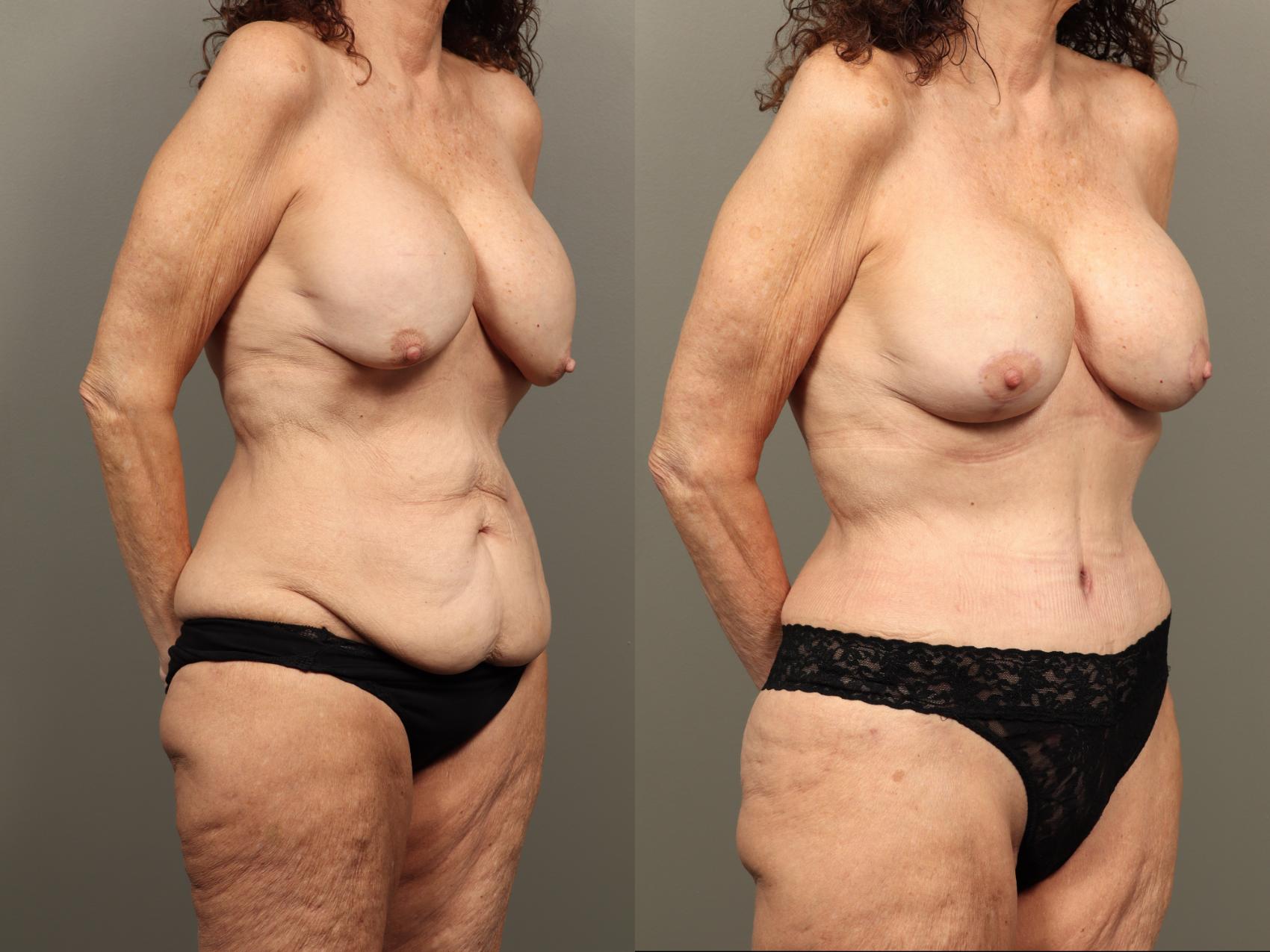 Before & After Mommy Makeover Case 490 Left Oblique View in Gilbert, AZ