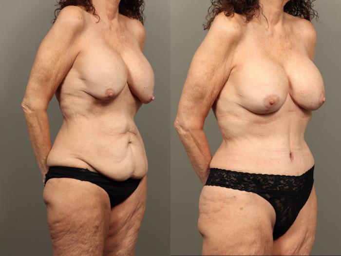Before & After Mommy Makeover Case 490 Left Oblique View in Gilbert, AZ