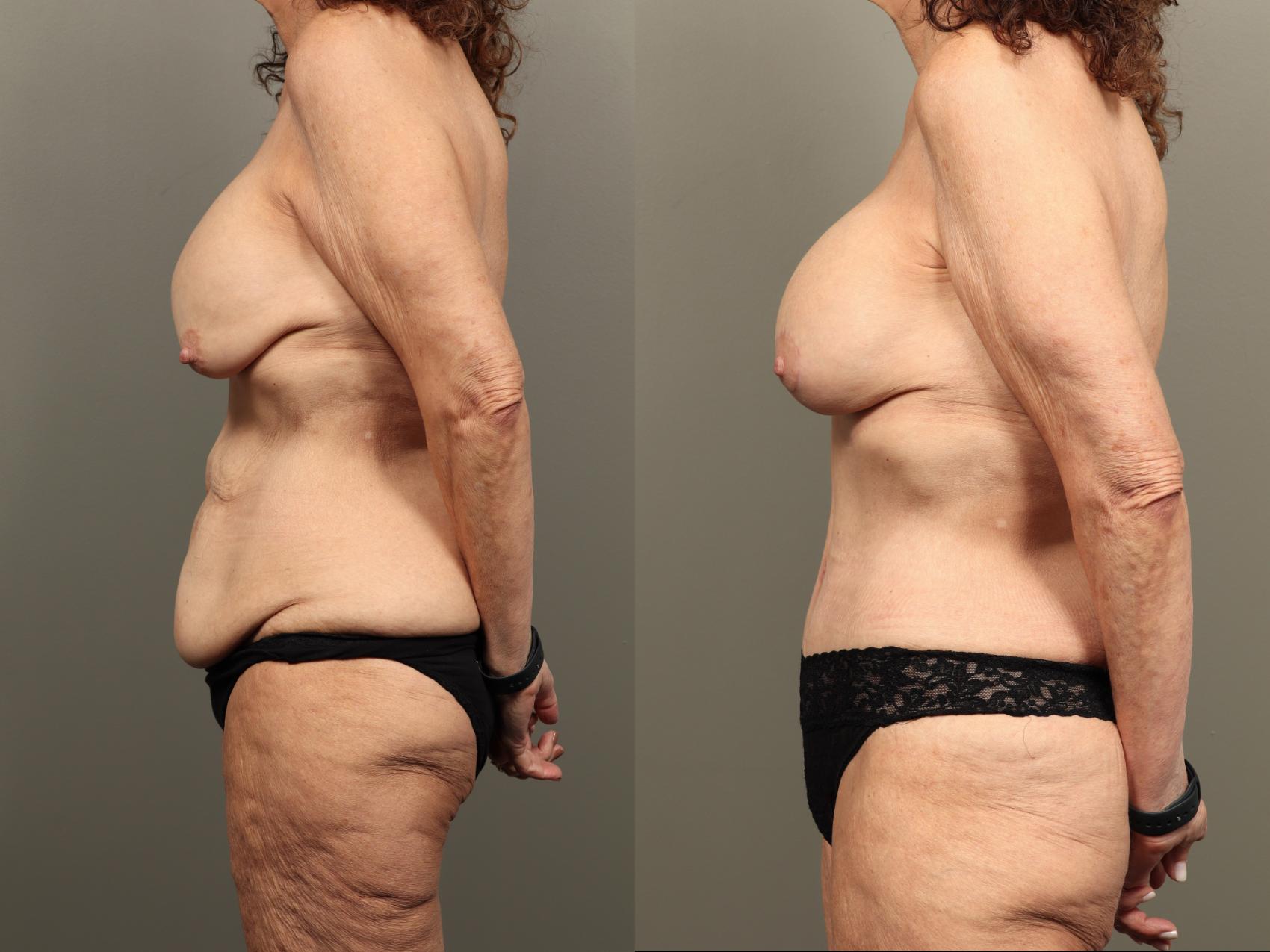 Before & After Mommy Makeover Case 490 Left Side View in Gilbert, AZ