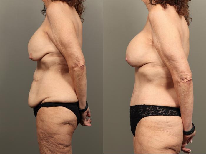 Before & After Mommy Makeover Case 490 Left Side View in Gilbert, AZ