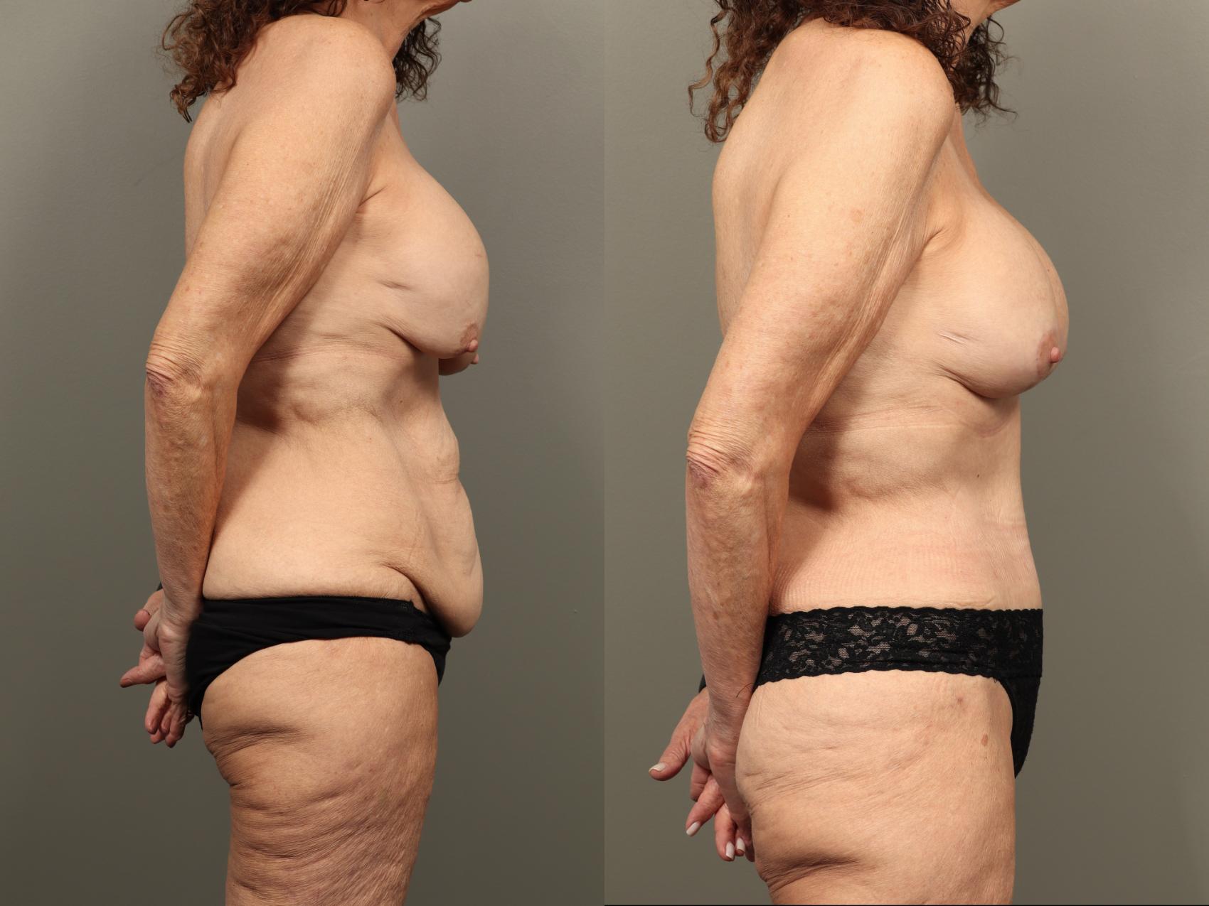 Before & After Mommy Makeover Case 490 Right Side View in Gilbert, AZ