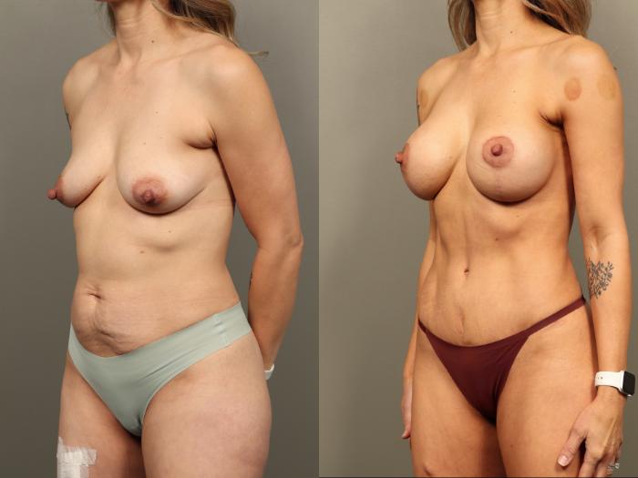 Before & After Mommy Makeover Case 491 Left Oblique View in Gilbert, AZ