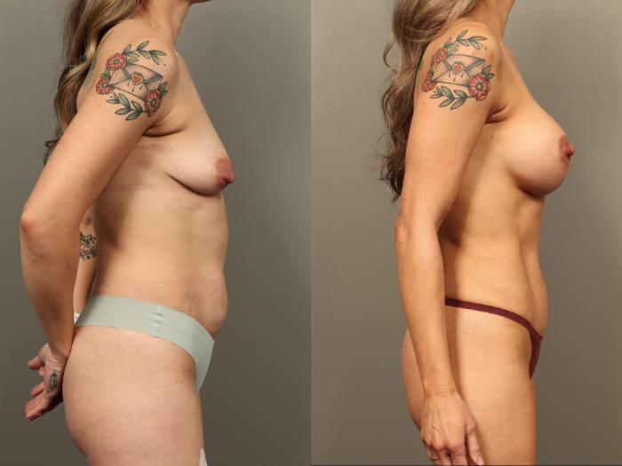 Before & After Mommy Makeover Case 491 Right Side View in Gilbert, AZ
