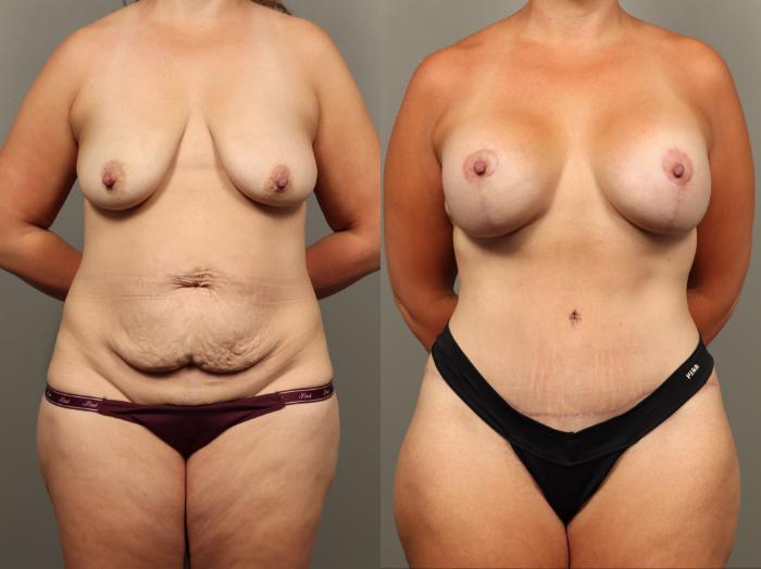 Before & After Mommy Makeover Case 496 Front View in Gilbert, AZ