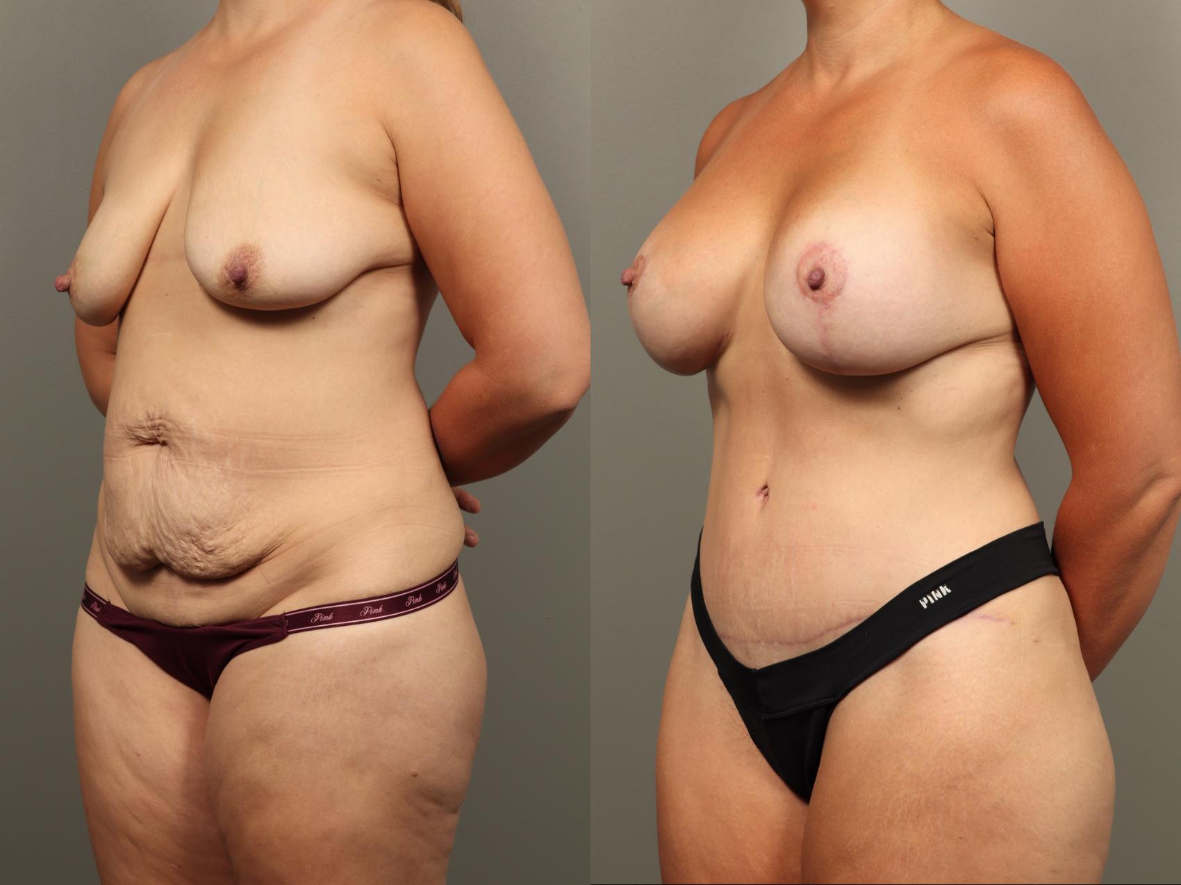 Before & After Mommy Makeover Case 496 Left Oblique View in Gilbert, AZ