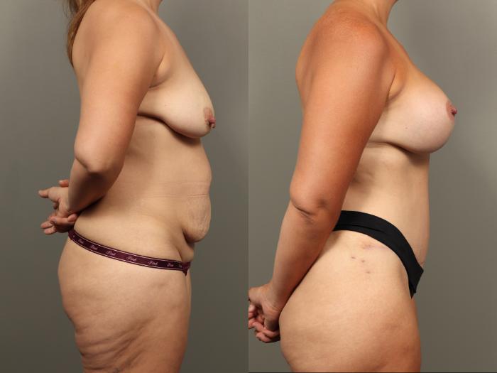 Before & After Mommy Makeover Case 496 Left Side View in Gilbert, AZ