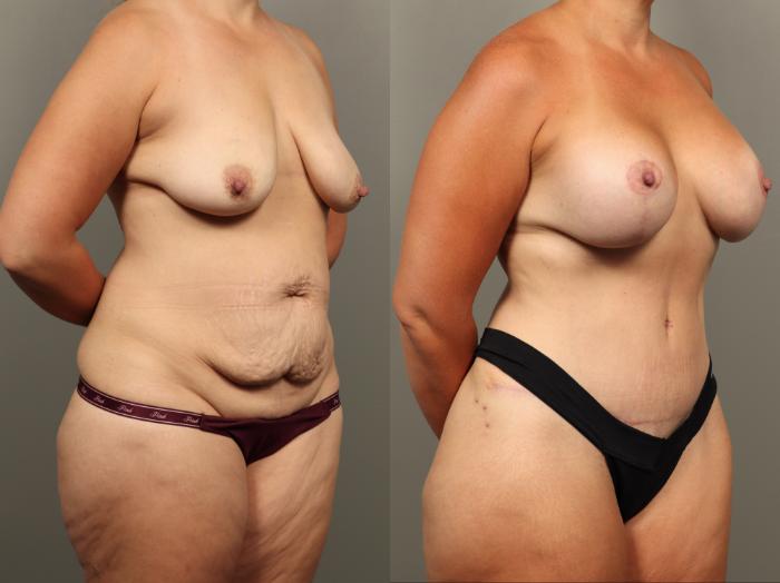 Before & After Mommy Makeover Case 496 Right Oblique View in Gilbert, AZ