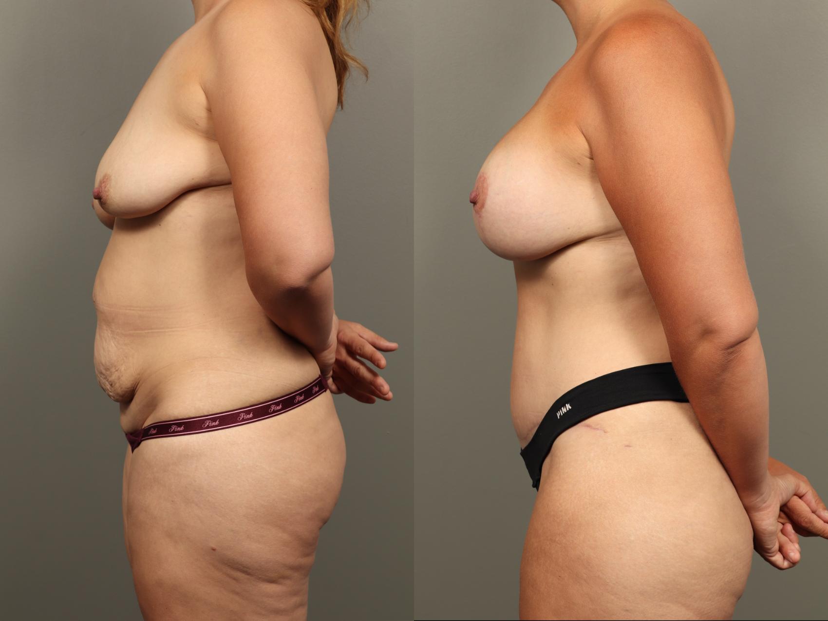 Before & After Mommy Makeover Case 496 Right Side View in Gilbert, AZ