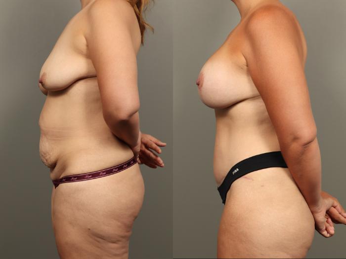 Before & After Mommy Makeover Case 496 Right Side View in Gilbert, AZ